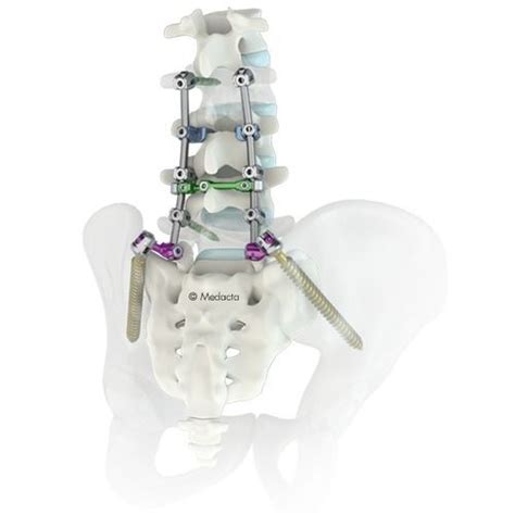 Lumbo Sacral Osteosynthesis Unit Must® Medacta Posterior Adult