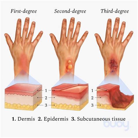 Classification Of Burns The Three Degrees Rcoolguides