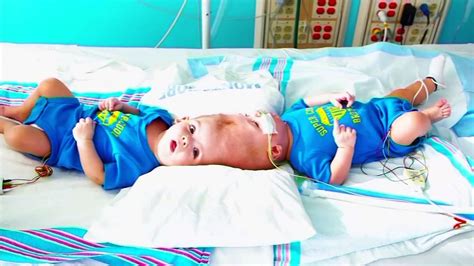 Conjoined Twins Attached At Head Separated After Surgery In New York Abc7 Los Angeles