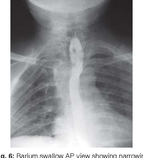 Figure 2 From A Case Of Plummer Vinson Syndrome Esophageal Web