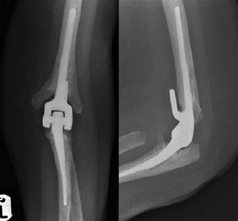 Arthritis The Shoulder And Elbow Clinic