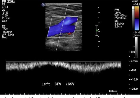 Figure 14 From Update On The Lower Extremity Venous Ultrasonography