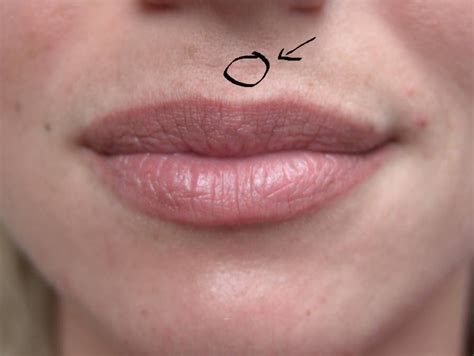 Dark Patch Above Upper Lip Horspeed