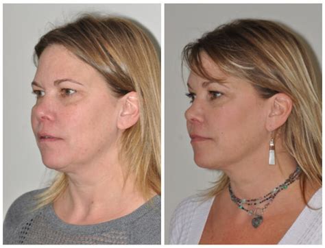 Patient 30624109 Facetite And Thermitight Before And After Photos Bloom