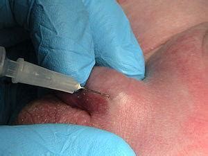 Tip Of Penis Benign Lesion Hot Nude Hot Sex Picture