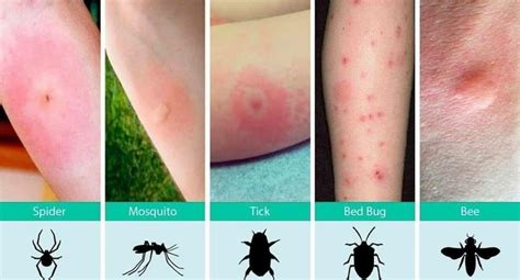 How To Recognize Various Bug Bites Rems