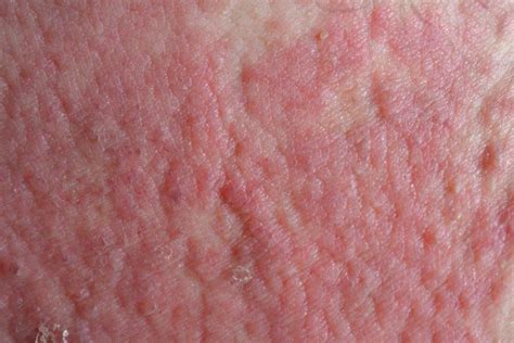Atopic Dermatitis Associated With Impaired Quality Of Life Overall