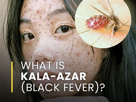 What Is Kala Azar Black Fever Causes Symptoms Risk Factors