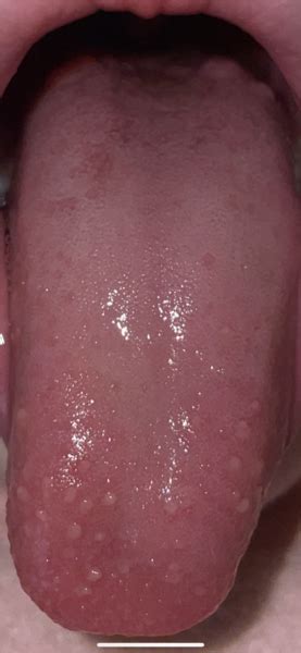 Dd Bumps On Tongue Mumsnet