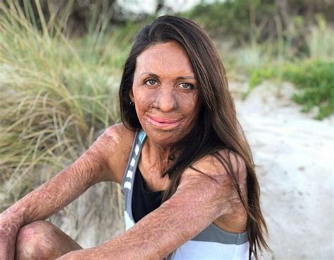 Turia Pitt Has Faced Endured And Overcome More Than Most Read Her Courageous Story And Life