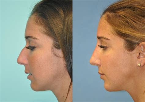 Non Surgical Rhinoplasty Before And After Photos Fairfax My Xxx Hot Girl
