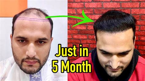 Case Study Amazing Hair Transplant Result Just In Month Month By