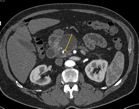 Acute And Chronic Pancreatitis With A Pseudocyst Pancreas Case