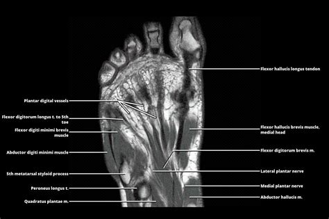 Mri Foot