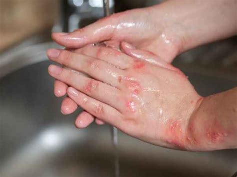 Eczema Scars What All You Should Know Tv Health