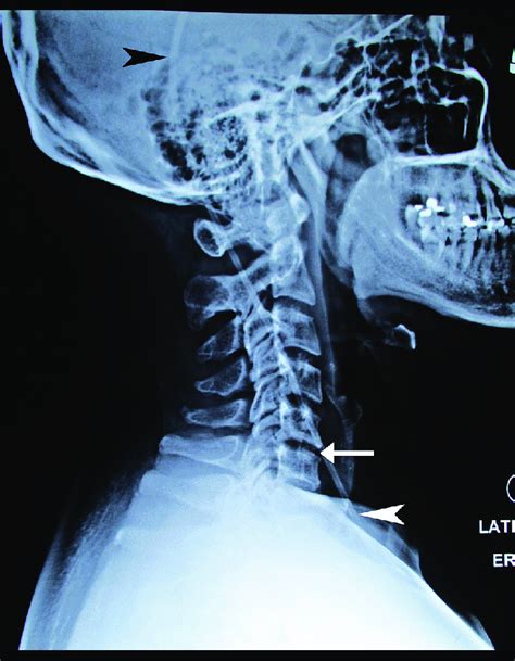 Lateral Cervical Spine Radiograph The Cervical Lordosis Is Visibly