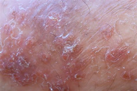 Close Up Photo Of Psoriasis Dermatitis Patient Wound Dry Skin Wound