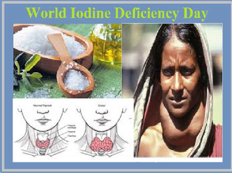 World Iodine Deficiency Day 2020 All You Need To Know