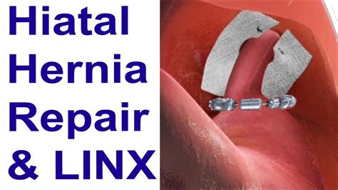 Hiatal Hernia Repair And Linx To Treat Reflux Animation Youtube