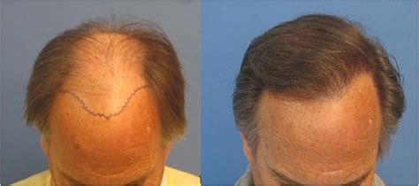 Hair transplant with quality for an affordable price ✔ only manual fue hair transplant by the surgeon himself, no assistants ✔. Mens Before and After Hair Transplant Photos