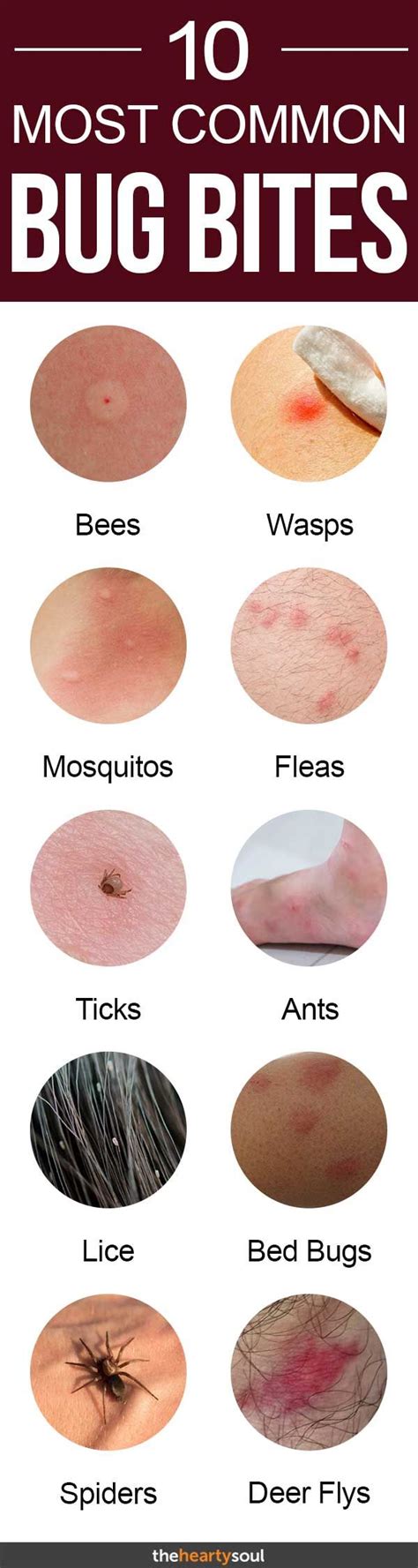Bug Bites Anyone Should Be Able To Identify Bug Bites Insect Bites Health And Beauty Tips