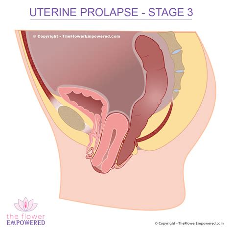 Uterine Prolapse Prolapsed Uterus Pelvic Organ Prolapse Stage 0 To 4
