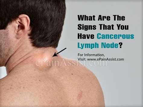 How To Know If You Have Cancer In Lymph Nodes Cancerwalls
