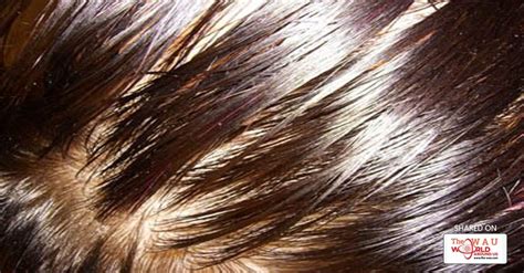 Oily Scalp Causes And Best Treatment For Oily Scalp Blog Health Wau