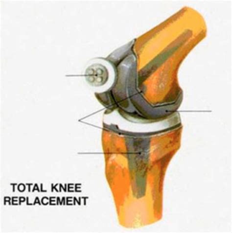 Test 2 Total Knee Replacement Diagram Quizlet