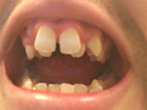 How To Fix A Crooked Smile Reddit How To Straighten Teeth Without