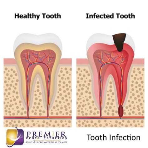 Tooth Infection Abscessed Tooth Pain Relief Causes Emergency