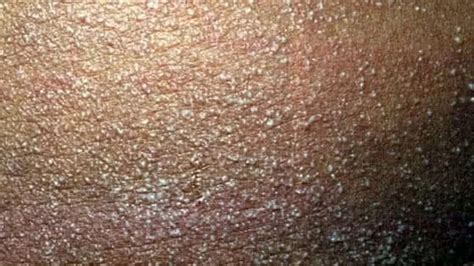View 10 Pictures Of Skin Rashes On Black Skin Bogohkesz