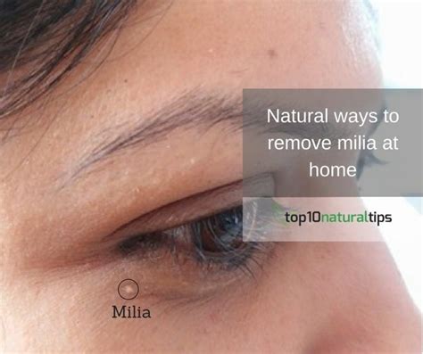 What Is Milia And How To Remove Milia At Home Top10 Natural Tips In