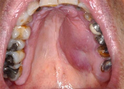 Palatal Swelling A Clinical Case Dentistry33