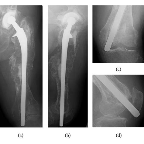 Radiographs Of The Left Femur And Knee At Initial Presentation