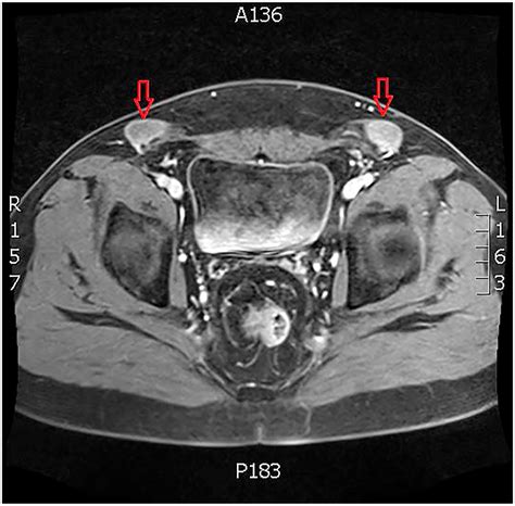 46 Xy 5 Alpha Reductase Deficiency In A 36 Year Old Phenotypic Female Patient Aace Clinical