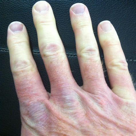 Raynauds Syndrome Hypothyroidism Rust Colored Stains On Hands