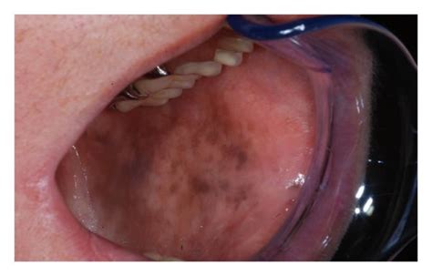 Pdf Oral Mucosa Pigmented Lesions An Overview Of The Recent Sexiz Pix