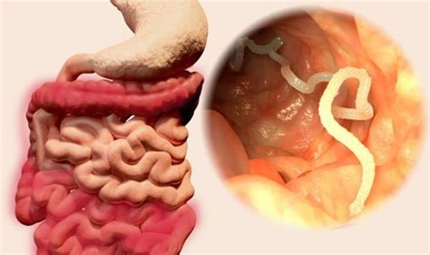 Tapeworm Symptoms How Do You Know If Youve Got Tapeworm Uk