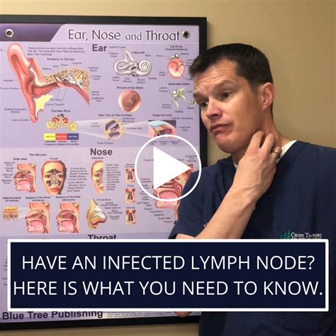 Have An Infected Lymph Node Here Is What You Need To Know — Dr Luke
