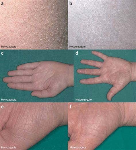 Clinical Appearance Of Ichthyosis Vulgaris Ace Full Presentation