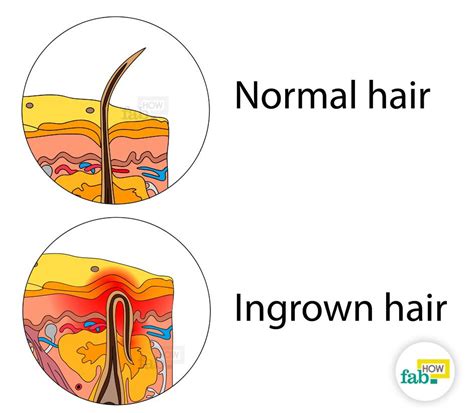 Ingrown hair in the pubic area will cause pain. How to Remove an Ingrown Hair Quickly without Laser | Fab How