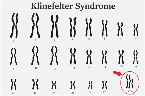 Cos è la sindrome di Klinefelter Plus Magazine