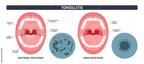Plakat Tonsil Stones Crypts Viral Virus Gland Strep Throat Sore
