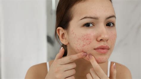 Whats Really Causing The Acne On Your Cheeks