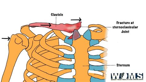 3 Types Of Clavicle Fracture Symptoms And Treatment Woms