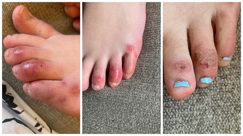 ‘covid Toes Other Skin Rashes Are The Latest Possible Rare