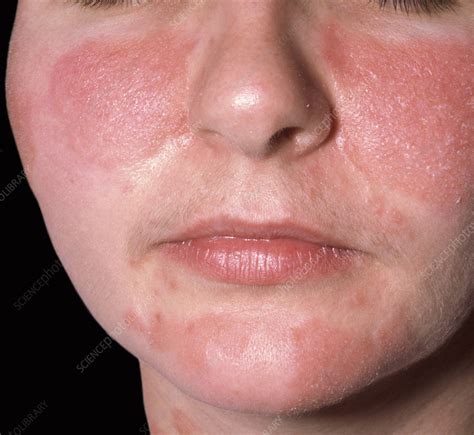 Seborrheic Dermatitis Face Women