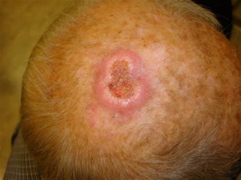 Squamous Cell Carcinoma