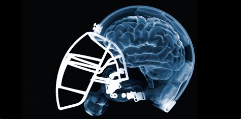 Football Injuries Chronic Traumatic Encephalopathy Cte Sports Injuries Pinterest Brain